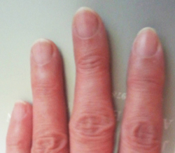 ７年間放置の突き指の痕　気功三角シール貼付後２週間の写真