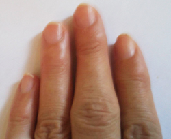 ７年間放置の突き指の痕